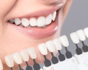 Clareamento Dental | Odontologia Giordano | Dentista em Sorocaba