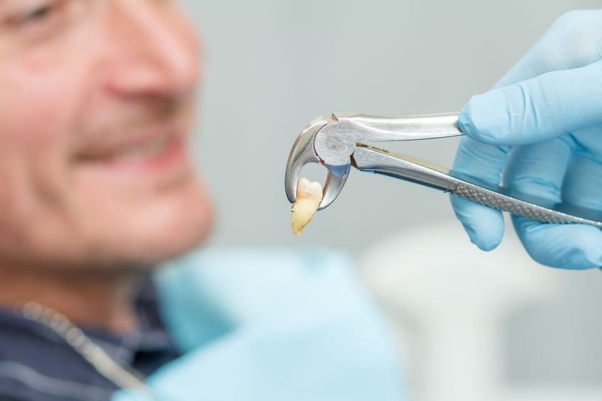 Extração de Dentes para Aparelhos Ortodônticos