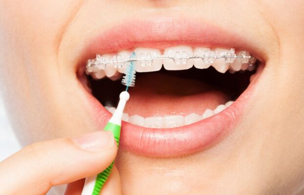 Como Higienizar o Aparelho Fixo | Dentista em Sorocaba | Odontologia Giordano